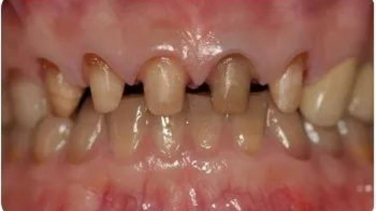 谭建国｜美学秘技002-如何减少活髓牙牙体预备术后牙髓敏感？