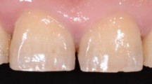 牙齿美学修复理论与实践学习班--前牙重度磨耗的美学和功能重建
