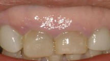 前牙美学分析与设计之三-上中切牙龈缘的确定