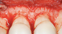 牙冠延长手术专家笔谈（二）-术前检查和准备