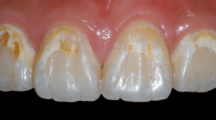 牙齿光滑面白垩斑样病损的树脂渗透治疗（一）
