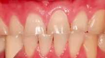 牙齿磨耗（一）-磨耗的物理原因