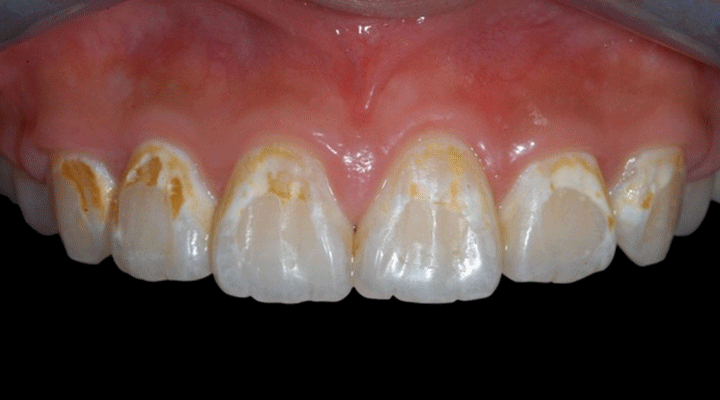 牙齿钙化不全的图片图片
